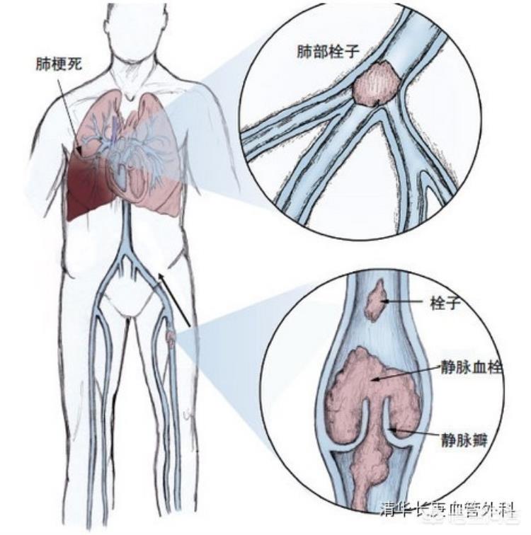 骨折手术后一到晚上更加疼痛难忍骨折疼痛如何缓解