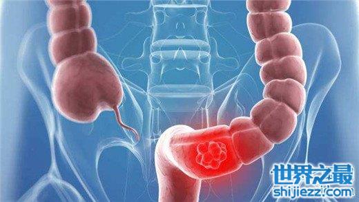 中国十大高发恶性肿瘤，早知征兆早预防 
