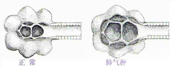 民间老年肺气肿偏方推荐辅助治疗小药方大成效